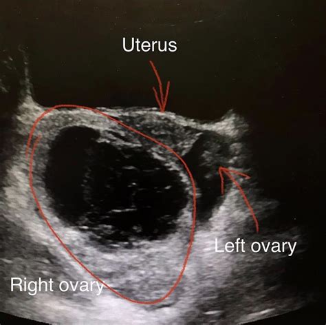 precautions in torsion test|ovarian torsion in adults.